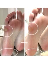 巻き爪フットケアサロン 神楽坂/タコ魚の目、カチカチかかとケア