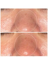 ちらちゅら/ハーブピーリング