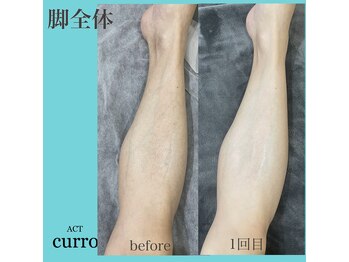 アクト クロ(ACT curro)/【脚全体】脱毛施術例