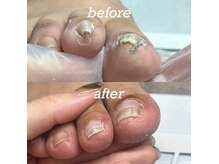 ネイルサロン ユーズ(USE.)の雰囲気（巻き爪ケアもお任せ下さい！参考画像はインスタ@use_nailcare）
