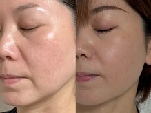 フェリス(FELIZ)/落ちにくいお顔の脂肪はお任せ