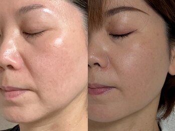 フェリス(FELIZ)/落ちにくいお顔の脂肪はお任せ