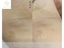 サロン ド レナ(Salon de LENA)/ハーブピーリング サロンドレナ