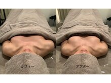 トリート(TREAT)/ビフォー&アフター　バストUP