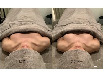 トリート(TREAT)/ビフォー&アフター バストUP
