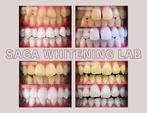 佐賀ホワイトニングラボ