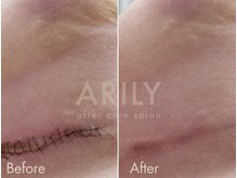 アリリィ(ARILY)/ダウンタイムケア/表参道/外苑前