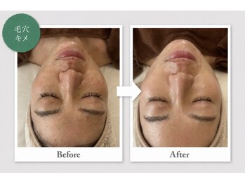 リ クリニカル ラボ(Re clinical Labo)の写真/韓国製品のシーナジーピール（ハーブピーリング）はニキビに特化したピーリングで即効性◎