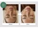 リ クリニカル ラボ(Re clinical Labo)の写真/韓国製品のシーナジーピール（ハーブピーリング）はニキビに特化したピーリングで即効性◎