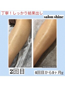 サロンシャイン(Salon Shine)/メンズ脱毛