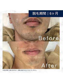 メンズクリア 松本店/【メンズクリア】お客様の施術例