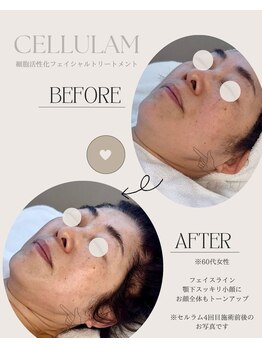 シェリア 桜新町/リフトアップ・二重顎のケアにも