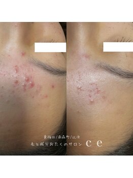 シャルム エスボーテ(charme Esbeaute)/ハーブピーリング肌質改善