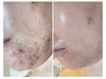 ストーリー 岐阜店(STORY)/ハーブピーリング専門店STORY