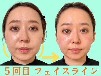 ナチュラルパーフェクトフェイス 新宿/５回目・歪み改善/新宿小顔矯正