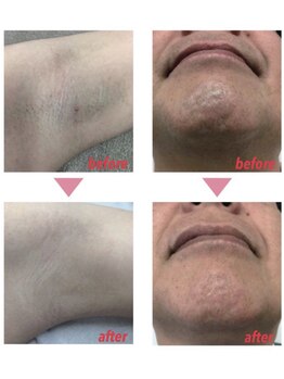 エムズスタイル ネイルバー(M's Style NAIL BAR)/ワキ脱毛とメンズヒゲ脱毛