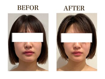 ルアバイアロ(Lua by Alo's)/大人気小顔コース