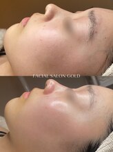 ゴールド 恵比寿店(GOLD)/毛穴洗浄とスキンケアの相乗効果