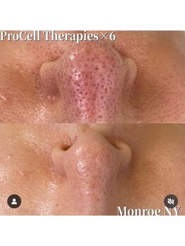 叶(Kanau)/プロセルセラピーズ肌質改善