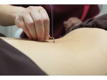 【鍼灸】1人ひとりのオーダーメイド施術。