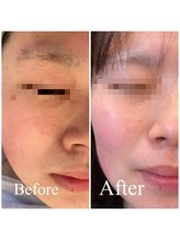 アトリエ ネリネ(Atelier neRine)/白玉肌に