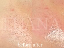 ルアナ(LUANA)/毛穴の黒ずみは産毛かも！？