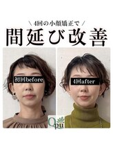 キュープ 松戸店(Qpu)/小顔矯正4回の変化