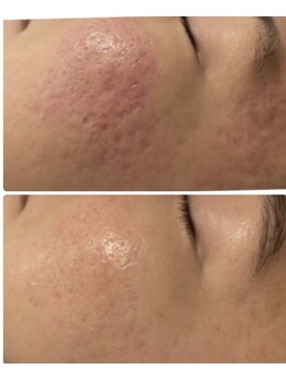 プレジール(Plaisir)/サーマトリックス