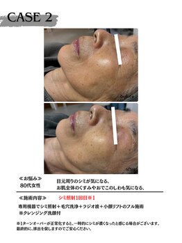 ミウル 天王寺店(miulu)/80代女性/シミ照射1回