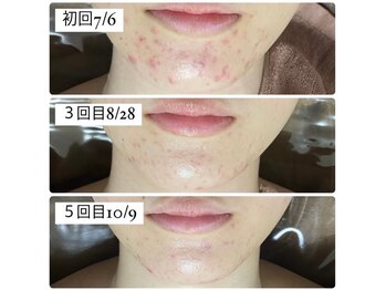 ハリト エステ(HaRi&)/毛穴洗浄/熊本/ハーブピーリング