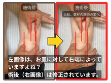 まこと整骨院/ひざ関節の痛　捻じれの整復症例