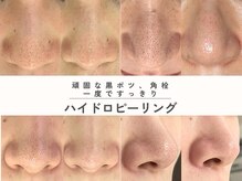 エス(es)の雰囲気（黒ずみ毛穴・角栓を徹底洗浄でつるんと美鼻へ透明感アップ実感！）