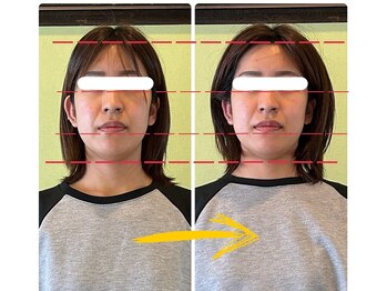 はあと/小顔調整