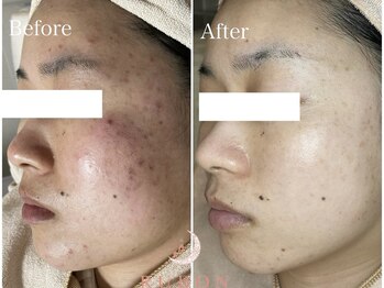 トータルビューティサロン ルボン(RUBON)/毛穴ニキビ症例