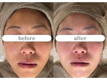 リスタ(RSTA)/【BEFORE/AFTER】