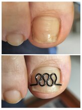 フレッシュフット(FreshFoot)/どんな巻き爪も対応★