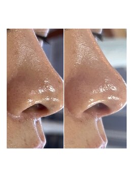 エクラ(eclat)/毛穴洗浄ケア