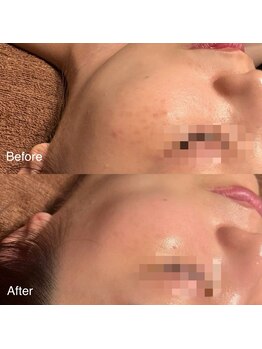 ユカリス(Yu.charis)/水光肌ミコステラ Before→After