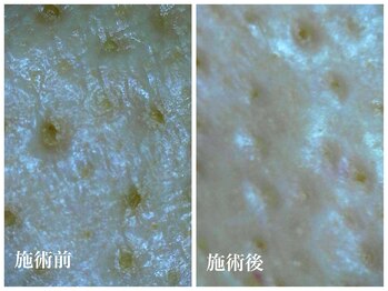 キーオブフェイス(Key of Face)/お悩み【毛穴のざらつき】