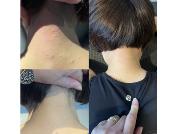 ハーモニーフィットネス 赤坂(Harmony Fitness)/原因不明の湿疹