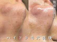 ダリア(Dahlia)/毛穴洗浄＋ララピール