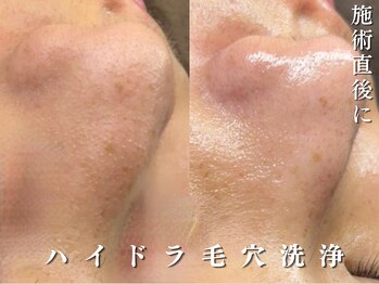 ダリア(Dahlia)/毛穴洗浄+ララピール