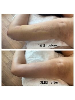 ムイエ(mouiller)/インディバ術後ケア 施術