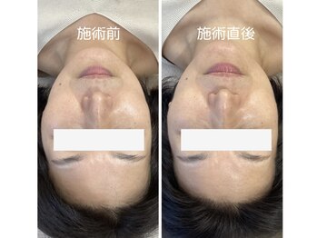 ムー(mu)/光フェイシャル