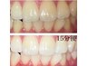 【学割U24】歯のホワイトニング！黄ばみ/くすみを除去1回¥1980