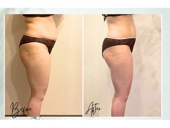 ポノ 茅ヶ崎(Pono.)/セルゼロ2か月の変化【痩身】