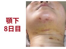アミュレット 京都(amulette)/【顎下＋・頬】8日目