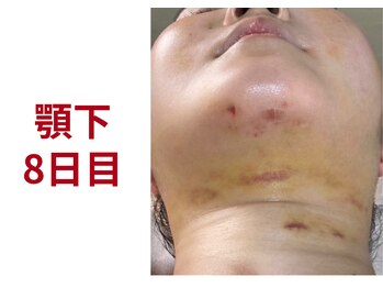 アミュレット 京都(amulette)/【顎下＋・頬】8日目