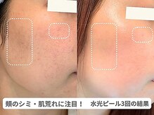 ピュアノア 垂水店/肌質改善フェイシャル　神戸垂水