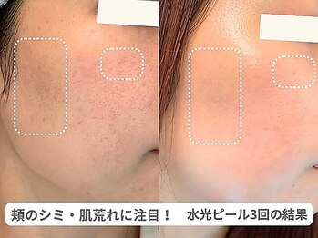 ピュアノア 垂水店/肌質改善フェイシャル 神戸垂水